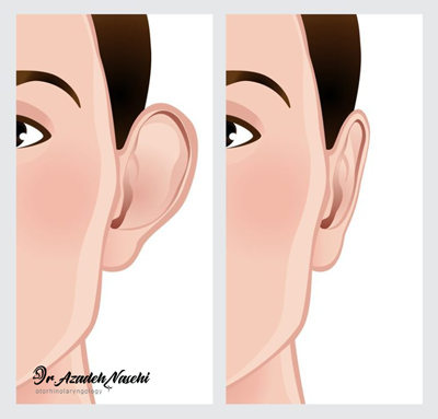 جراحی زیبایی گوش ( اتوپلاستی ) دکتر آزاده ناصحی - otoplasty