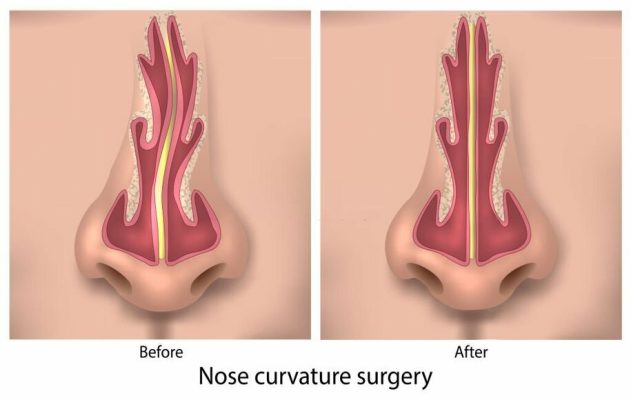 جراحی بینی در ترکیه